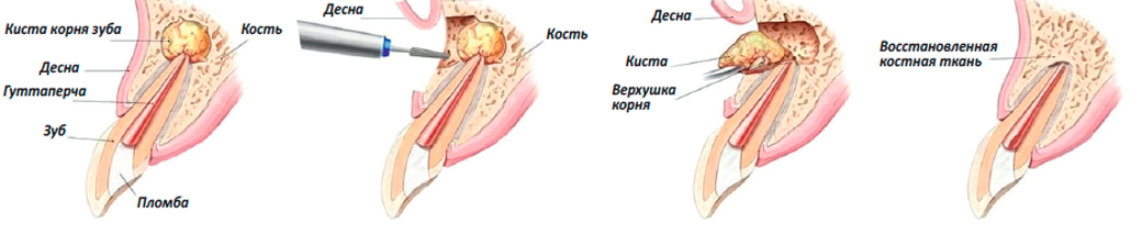 Одонтогенная киста 