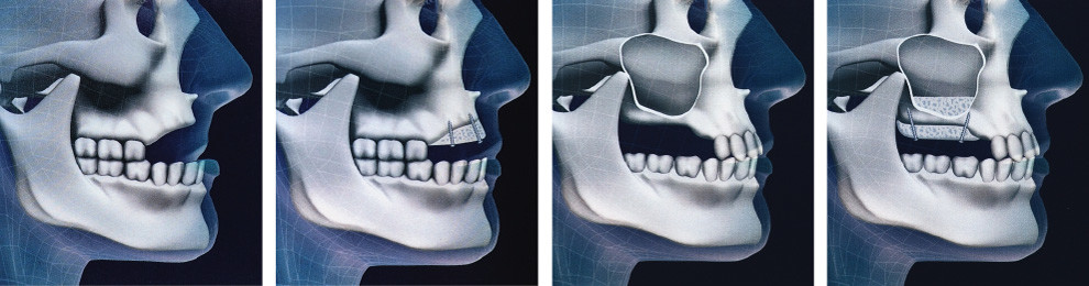 Bone grafting*