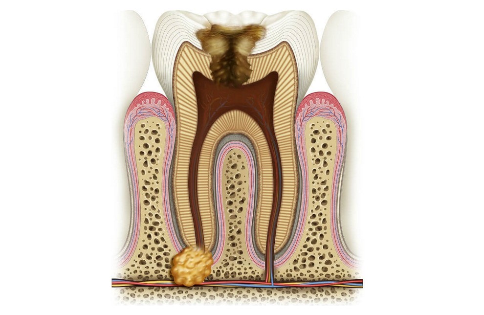 PERIRADICULAR SURGERY*