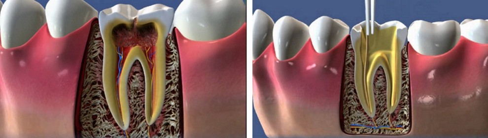 TREATMENT OF PERIODONTITIS*